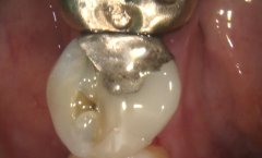 Before and After Dental Crowns | Dental Excel