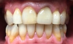 Before and After Dental Work | Dr Emma