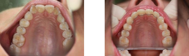 Before and After Dental Work | Orthodontics
