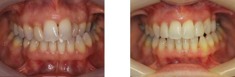 Before and After Dental Work | Orthodontics