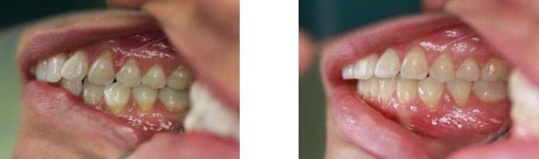 Before and After Dental Work | Orthodontics