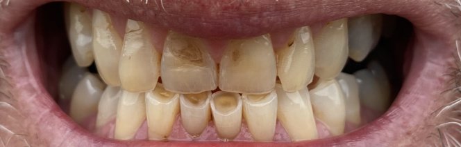 Before and After Dental Veneers | Dental Excel