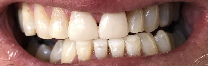Before and After Dental Work | Veneers