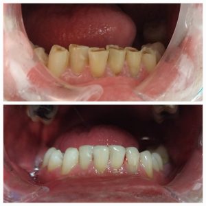 Dental work from Dr Haash (Dentist Beerwah)