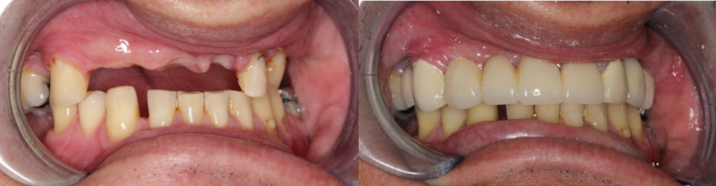 Before & After Dental Implants | Dental Excel