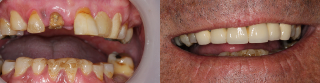 Before & After Dental Implants | Dental Excel