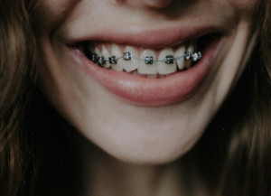 Dental Braces for Straight Teeth