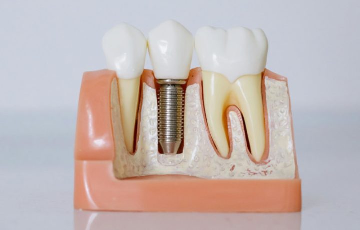 Dental Implants: A comprehensive guide