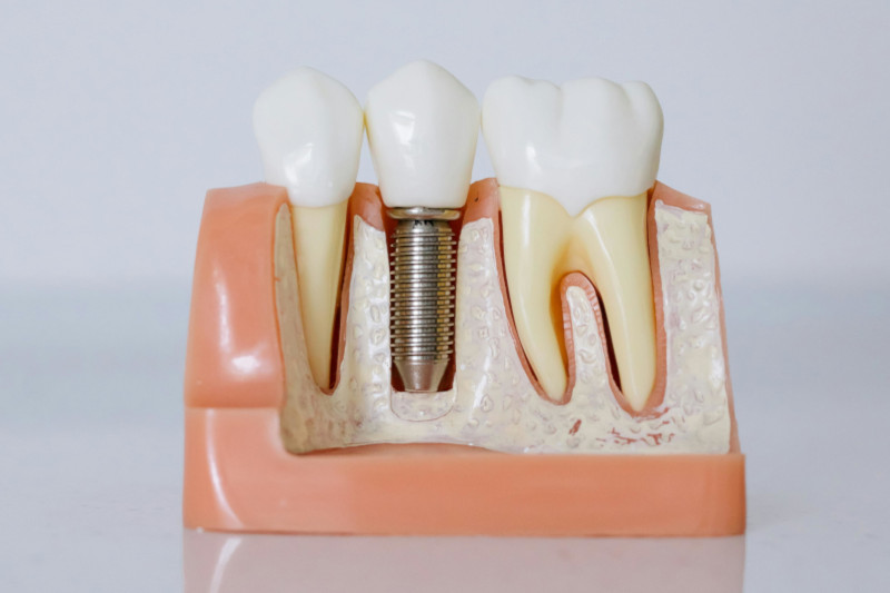 Dental Implants: A comprehensive guide